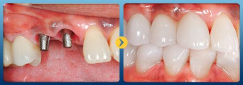 Trồng răng sứ giá bao nhiêu tiền là hợp lý nhất? 1 Trồng răng sứ giá bao nhiêu tiền là hợp lý nhất? 1