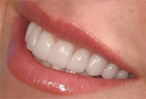 Trồng răng sứ giá bao nhiêu tiền là hợp lý nhất? 2 Trồng răng sứ giá bao nhiêu tiền là hợp lý nhất? 2