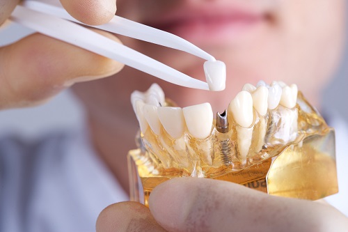 Trồng răng cửa có đau không - Thực hiện nhanh không 1 Trồng răng cửa có đau không - Thực hiện nhanh không 1