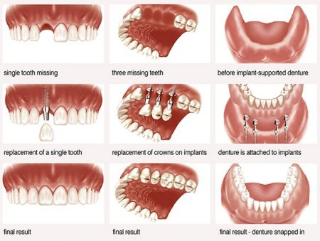 Trồng răng cửa có đau không - Thực hiện nhanh không? 2 Trồng răng cửa có đau không - Thực hiện nhanh không? 2