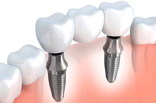 Trồng răng cửa có đau không - Thực hiện nhanh không 3 Trồng răng cửa có đau không - Thực hiện nhanh không 3