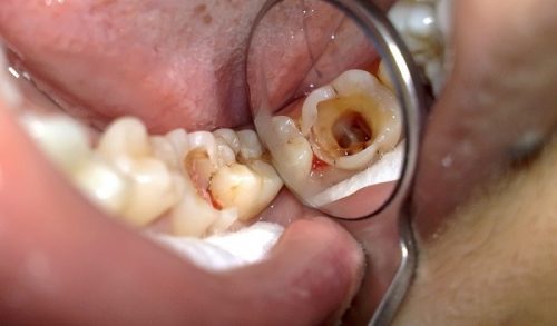 Bọc răng sứ có phải lấy tủy không? 1 Bọc răng sứ có phải lấy tủy không? 1