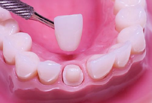 Bọc răng sứ có phải lấy tủy không? 2