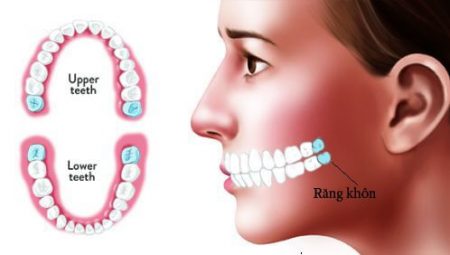 Lúc nào thì mọc răng khôn? 1 Lúc nào thì mọc răng khôn? 1