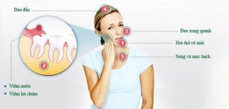 Lúc nào thì mọc răng khôn? 2 Lúc nào thì mọc răng khôn? 2