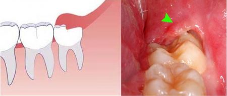 Dấu hiệu mọc răng khôn ở người lớn 2 Dấu hiệu mọc răng khôn ở người lớn 2