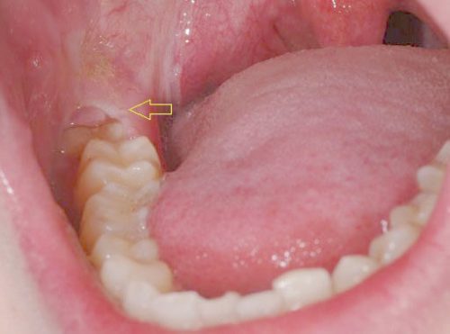 Mọc răng khôn trong bao lâu vậy? 1 Mọc răng khôn trong bao lâu vậy? 1