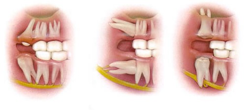 Mọc răng khôn trong bao lâu vậy? 2 Mọc răng khôn trong bao lâu vậy? 2