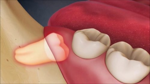 Nhổ răng khôn có nguy hiểm không? 1 Nhổ răng khôn có nguy hiểm không? 1