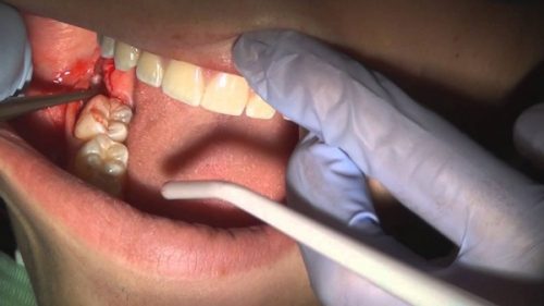 Nhổ răng khôn đau mấy ngày là hết? 2 Nhổ răng khôn đau mấy ngày là hết? 2