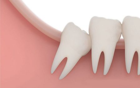 Nhổ răng khôn giá bao nhiêu tiền? 1 Nhổ răng khôn giá bao nhiêu tiền? 1
