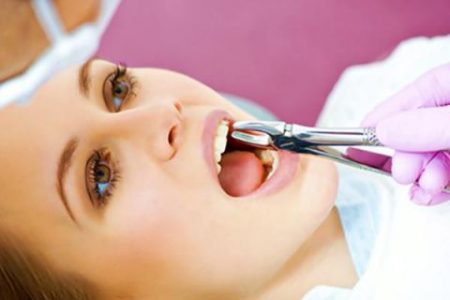 Nhổ răng khôn không nên ăn gì để đảm bảo? 2 Nhổ răng khôn không nên ăn gì để đảm bảo? 2