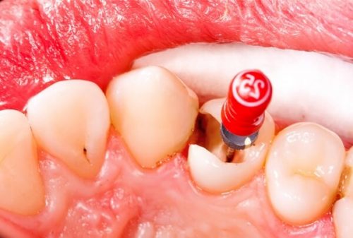 Răng lấy tủy có nên bọc lại không? 1 Răng lấy tủy có nên bọc lại không? 1