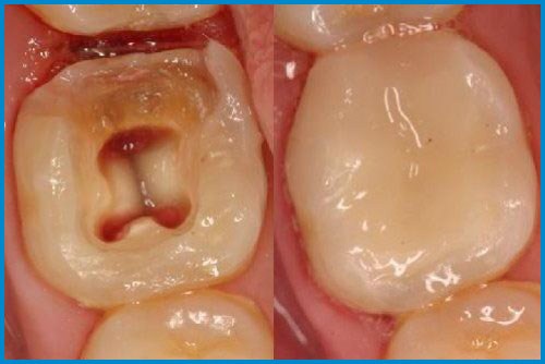 Răng lấy tủy có nên bọc lại không? 2 Răng lấy tủy có nên bọc lại không? 2