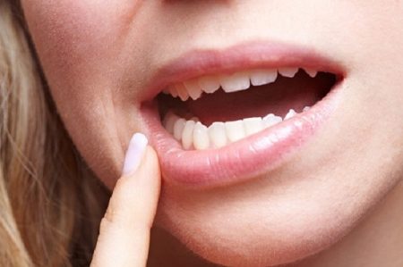 Răng khôn bị lung lay phải làm sao? Nguyên nhân và cách khắc phục 1 Răng khôn bị lung lay phải làm sao? Nguyên nhân và cách khắc phục 1