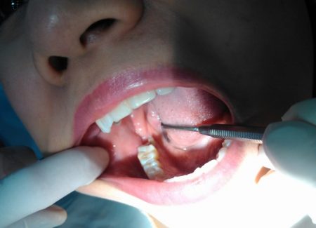 Răng khôn bị lung lay phải làm sao? Nguyên nhân và cách khắc phục 2 Răng khôn bị lung lay phải làm sao? Nguyên nhân và cách khắc phục 2