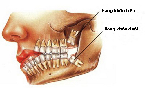 Răng khôn bị sâu nên nhổ hay trám? 1 Răng khôn bị sâu nên nhổ hay trám? 1