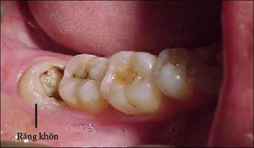 Răng khôn bị sâu nên nhổ hay trám? 2 Răng khôn bị sâu nên nhổ hay trám? 2