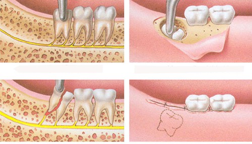 Răng khôn hàm trên bị vỡ - Hướng xử lý an toàn cho bạn 2