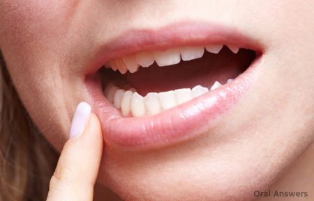 Răng khôn mọc lệch có nên nhổ không? 2 Răng khôn mọc lệch có nên nhổ không? 2