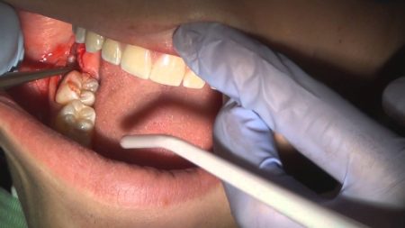 Răng khôn mọc lệch có nên nhổ không? 3 Răng khôn mọc lệch có nên nhổ không? 3