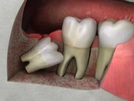 Răng khôn mọc ngầm có nên nhổ không? 1