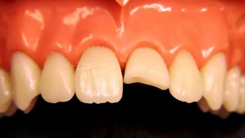 Răng sứ bị mẻ vỡ phải làm sao? 2 Răng sứ bị mẻ vỡ phải làm sao? 2
