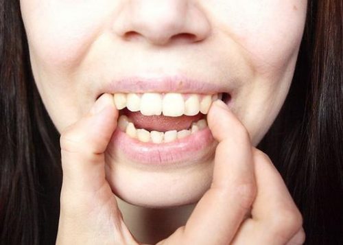 Bọc răng sứ có niềng được không? 1