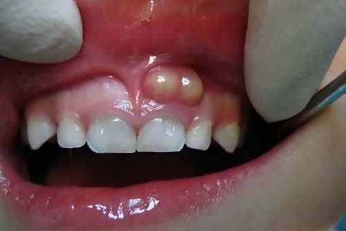 Viêm chân răng có mủ điều trị ra sao giúp giảm đau? 1 Viêm chân răng có mủ điều trị ra sao giúp giảm đau? 1