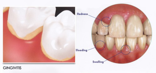 Mẹo chữa viêm chân răng tại nhà cho bạn 1 Mẹo chữa viêm chân răng tại nhà cho bạn 1