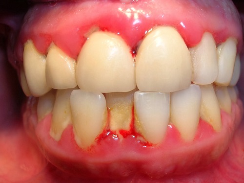 Bị viêm chân răng có nguy hiểm không? 1 Bị viêm chân răng có nguy hiểm không? 1
