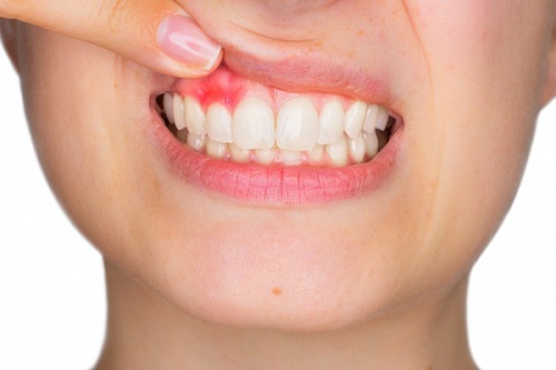 Bị viêm chân răng có nguy hiểm không? 2 Bị viêm chân răng có nguy hiểm không? 2