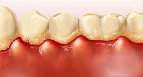 Viêm lợi hở chân răng là do đâu? 1 Viêm lợi hở chân răng là do đâu? 1