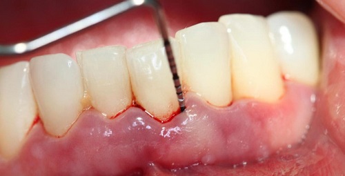 Viêm lợi hở chân răng là do đâu? 2 Viêm lợi hở chân răng là do đâu? 2