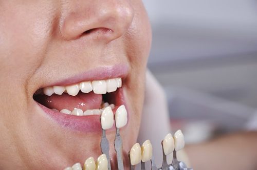 Có nên bọc răng sứ thẩm mỹ không? 2 Có nên bọc răng sứ thẩm mỹ không? 2