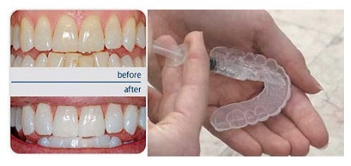 Hướng dẫn tẩy trắng răng tại nhà bằng thuốc 2 Hướng dẫn tẩy trắng răng tại nhà bằng thuốc 2