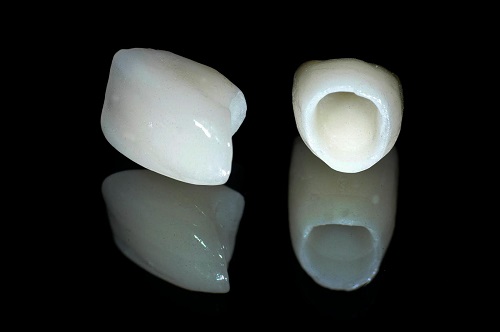 Bọc răng sứ chữa hô có mang lại hiệu quả không? 1 Bọc răng sứ chữa hô có mang lại hiệu quả không? 1
