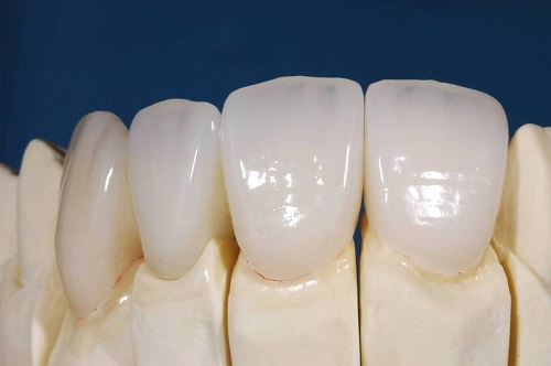 Bọc răng sứ ở đâu đẹp và tự nhiên nhất? 4 Bọc răng sứ ở đâu đẹp và tự nhiên nhất? 4
