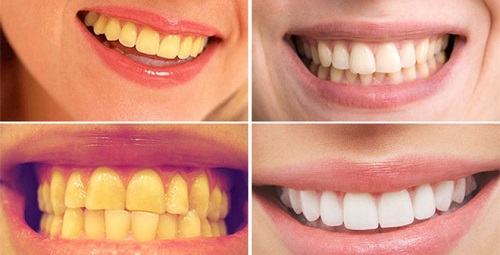 Bột tẩy trắng răng eucryl có tốt không? Một số review của khách hàng 3