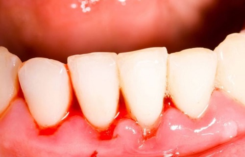 Chảy máu chân răng buổi sáng nguyên nhân chính do đâu? 2 Chảy máu chân răng buổi sáng nguyên nhân chính do đâu? 2