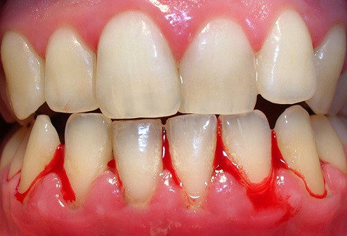 Chảy máu nướu răng đừng xem nhẹ có thể biểu hiện bệnh nguy hiểm 1 Chảy máu nướu răng đừng xem nhẹ có thể biểu hiện bệnh nguy hiểm 1