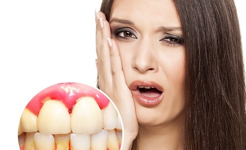 Chảy máu nướu răng đừng xem nhẹ có thể biểu hiện bệnh nguy hiểm 2 Chảy máu nướu răng đừng xem nhẹ có thể biểu hiện bệnh nguy hiểm 2