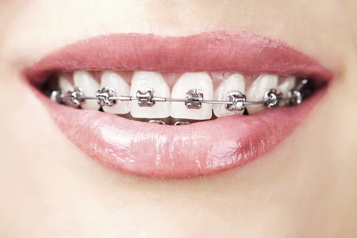 Chi phí niềng răng mắc cài tự đóng bao nhiêu? 1 Chi phí niềng răng mắc cài tự đóng bao nhiêu? 1