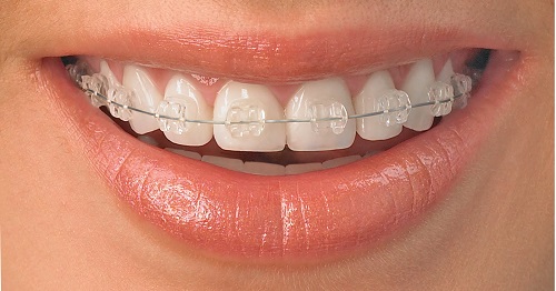 Chi phí niềng răng mắc cài tự đóng bao nhiêu?