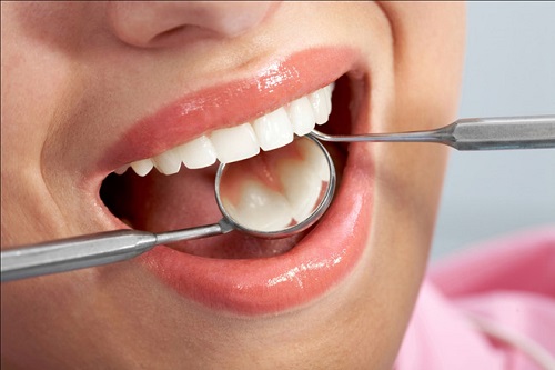3 cách chỉnh răng đều không cần niềng cho bạn 1 3 cách chỉnh răng đều không cần niềng cho bạn 1