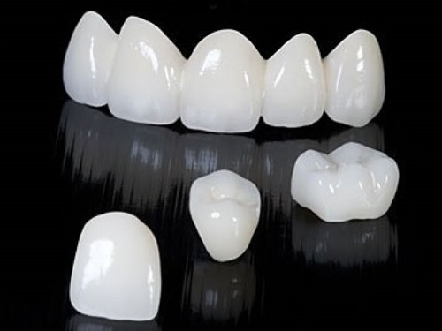 3 cách chỉnh răng đều không cần niềng cho bạn 2 3 cách chỉnh răng đều không cần niềng cho bạn 2