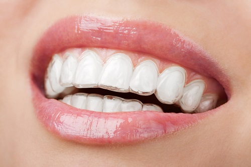 Có nên đi niềng răng không? Những trường hợp nên niềng răng 2 Có nên đi niềng răng không? Những trường hợp nên niềng răng 2