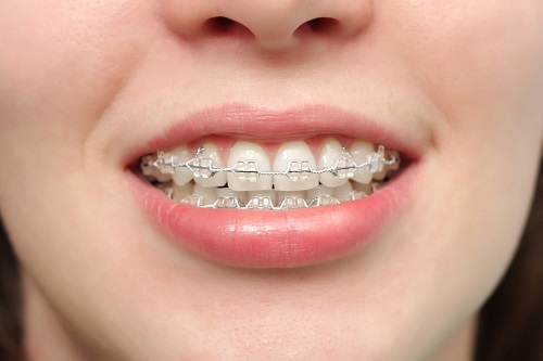 Có nên đi niềng răng không? Những trường hợp nên niềng răng 3 Có nên đi niềng răng không? Những trường hợp nên niềng răng 3
