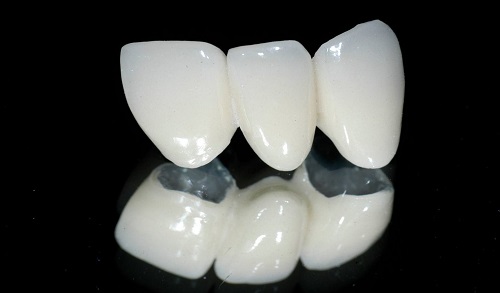 Phương pháp dán răng sứ thẩm mỹ không cần mài răng cho bạn 1 Phương pháp dán răng sứ thẩm mỹ không cần mài răng cho bạn 1