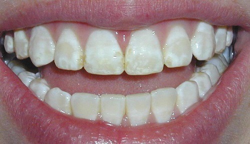 Cách sử dụng gel tẩy trắng răng đơn giản nhất 3 Cách sử dụng gel tẩy trắng răng đơn giản nhất 3